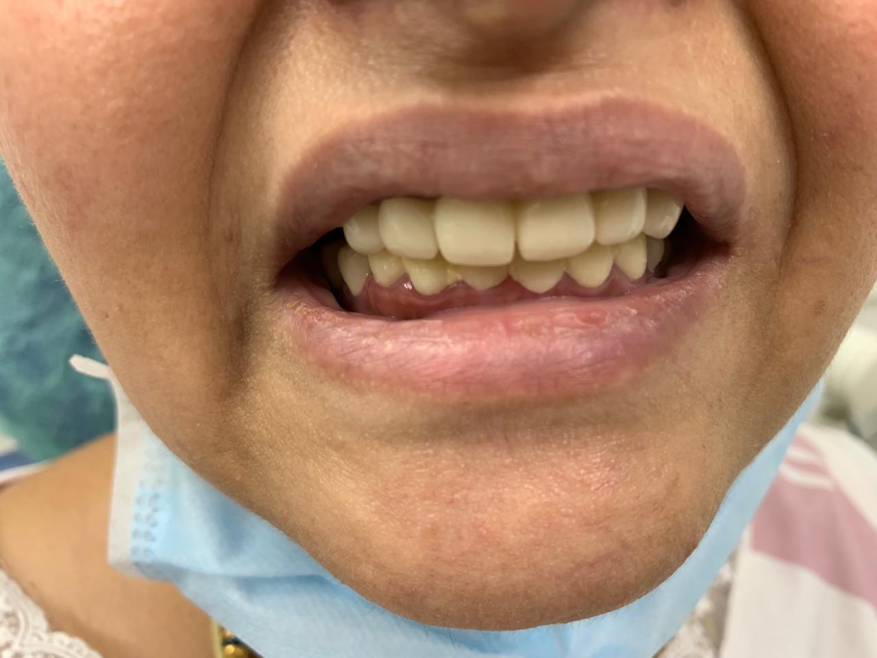 Full mouth rehabilitation: Severely attrited teeth restored with multiple root pins and zirconium crowns treatment